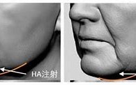 面部填充的艺术如何避免馒化现象，实现自然美