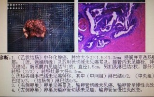 年轻直肠癌患者伴肝 肺转移,经过这些治疗以后