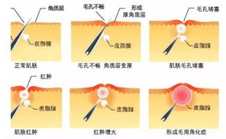 一键磨皮奇迹探索闭口鸡皮热门本命大牌精华水的秘密-第1张图片-彩蝶百科