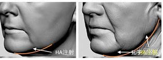 面部填充的艺术如何避免馒化现象，实现自然美-第1张图片-彩蝶百科