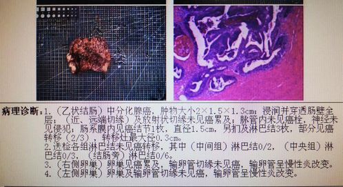 年轻直肠癌患者伴肝 肺转移,经过这些治疗以后-第1张图片-彩蝶百科 年轻直肠癌患者伴肝 肺转移,经过这些治疗以后-第1张图片-彩蝶百科