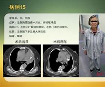 肺鳞癌术后化疗的必要性与预防复发的策略-第1张图片-彩蝶百科 肺鳞癌术后化疗的必要性与预防复发的策略-第1张图片-彩蝶百科
